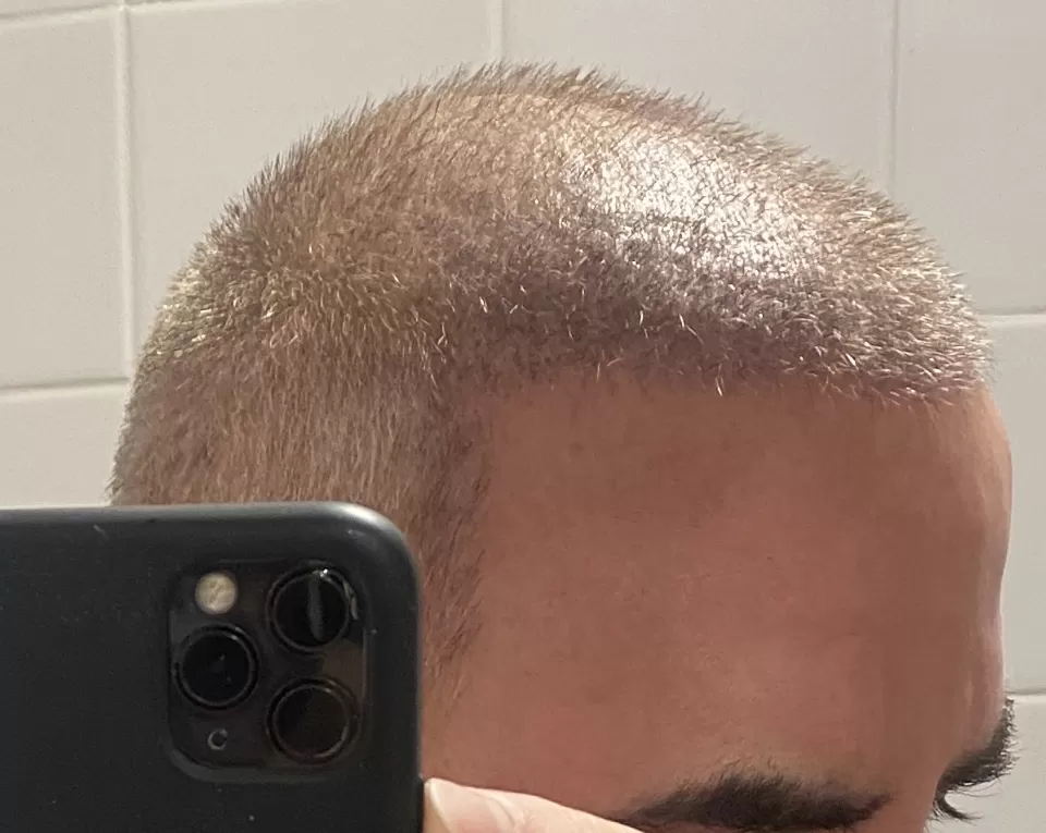Hair Transplant Institute - Dra. Alba Reyes Sagiv - Photo 3