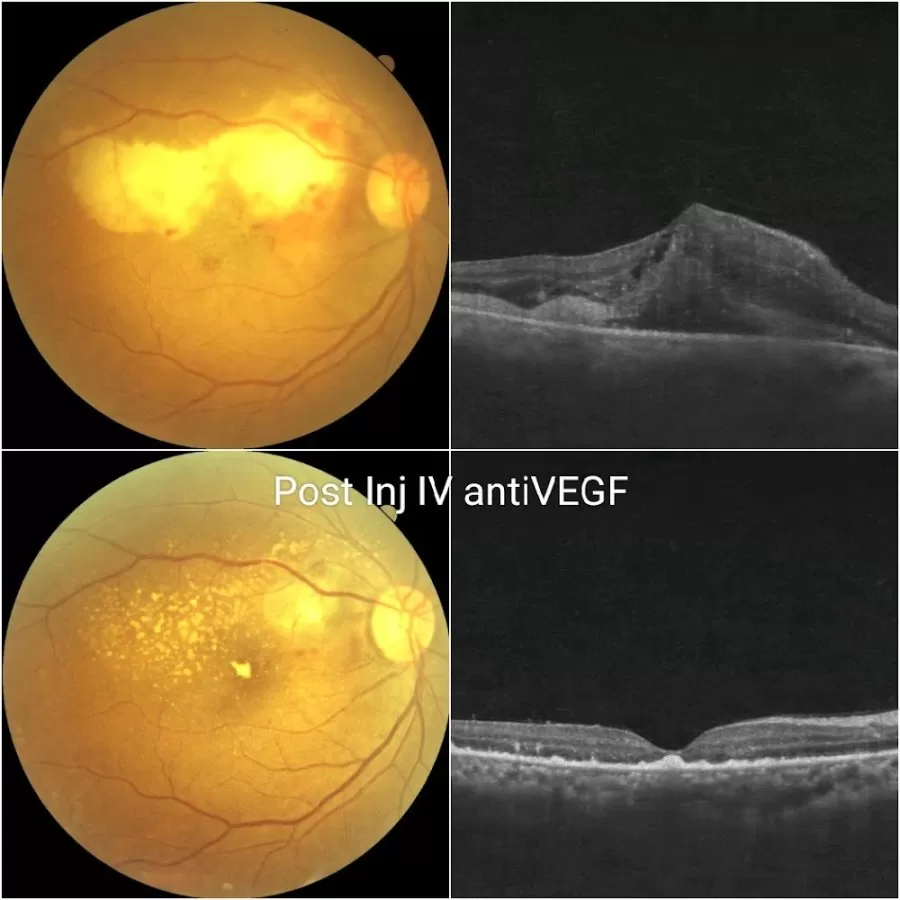 Siya Retina Centre, Eye Hospital,Dr Shalin N.Shah(Vadodara main branch) - Photo 5