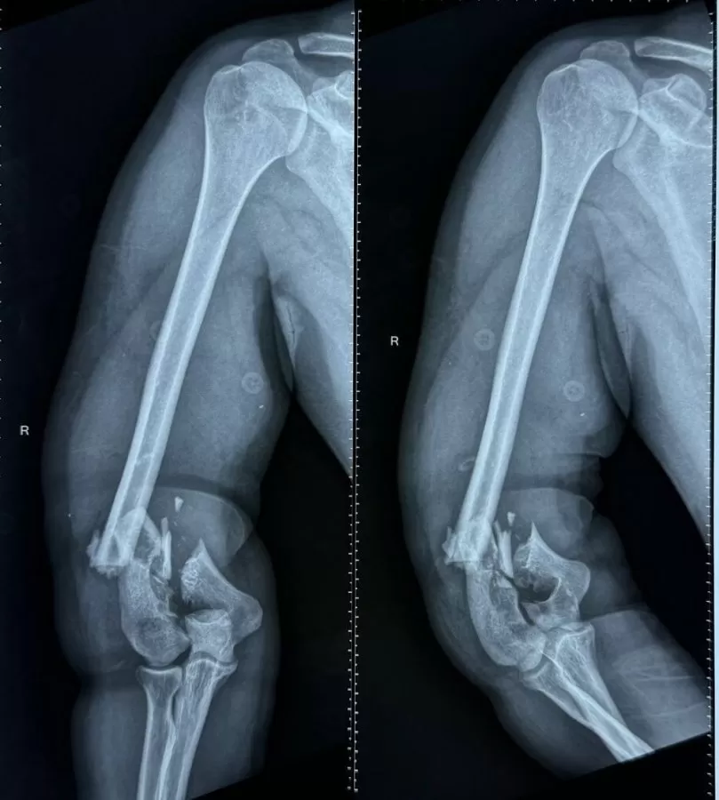 Atlas Orthocare Clinic by Dr Ssamy C Ajay-MS Ortho(AIIMS) MRCS(England) Ex SR (JIPMER&AIIMS) Best Orthopaedic surgeon-Chennai - Photo 2
