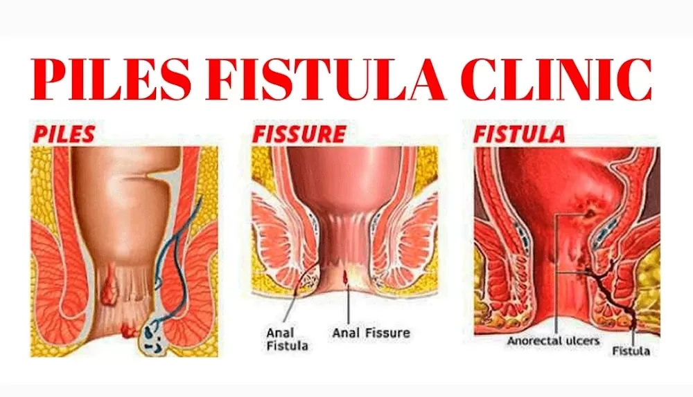 Piles Fissure & Fistula - New Sangavi - Photo 4