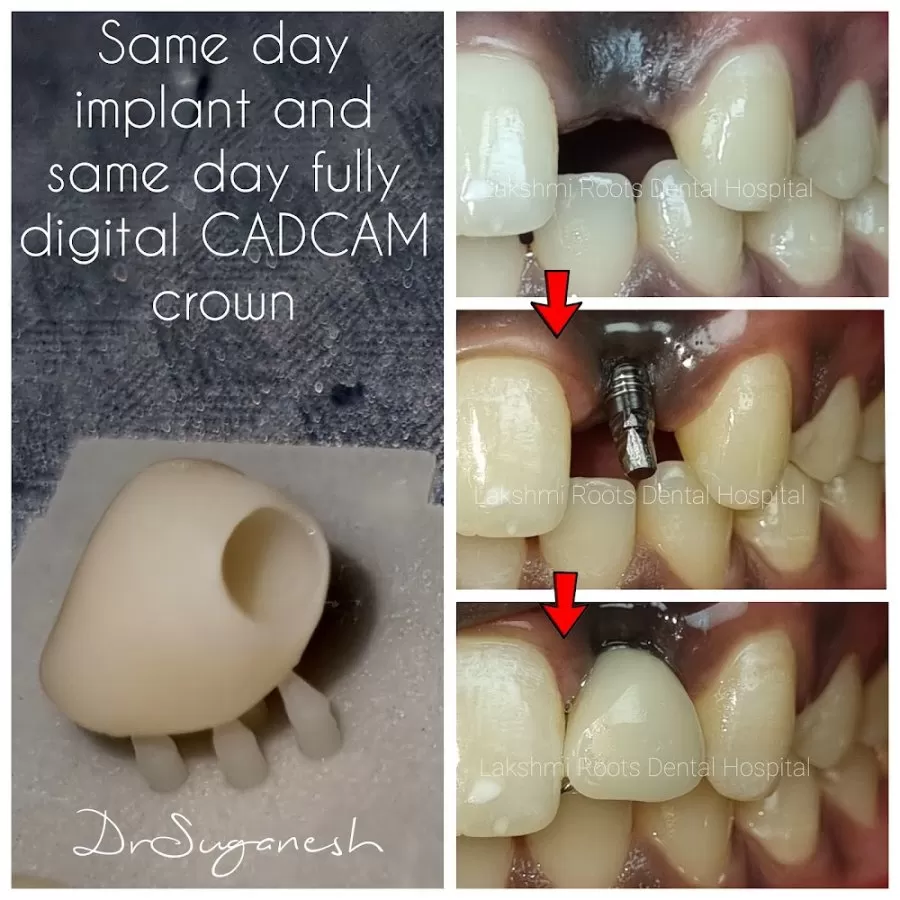 Lakshmi Roots Dental Hospital and Implant Centre- Dr Suganesh BEST DENTIST VILLIVAKKAM - Photo 7
