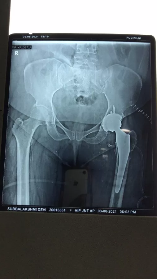 Dr Mithun N Oswal - Best Orthopedic Surgeon in Bangalore- Knee Hip Joint Replacement Surgeon in Bangalore, ACL surgery - Photo 1