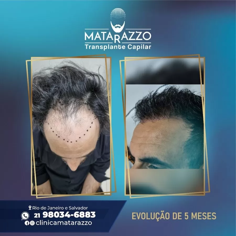 Clínica Matarazzo Transplante Capilar RJ - Photo 8