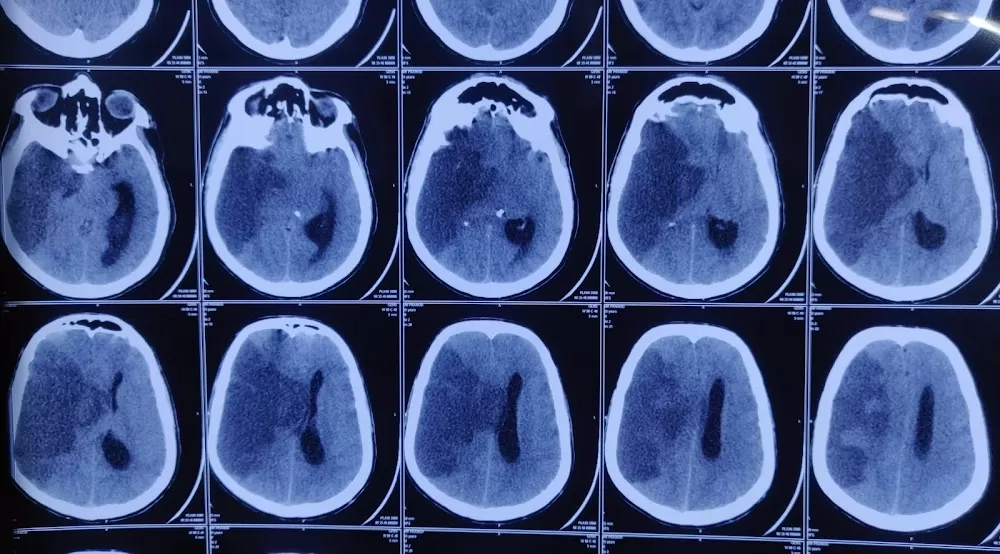 Dr. Anjeev. K. Chaurasiya - Best Neurosurgeon | Brain Tumor | Stroke | Spine Surgeon | Headache | Doctor | Bhopal - Photo 8