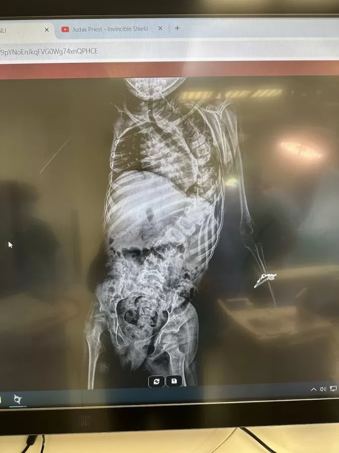 orthopedic surgery, spine surgery - Photo 8