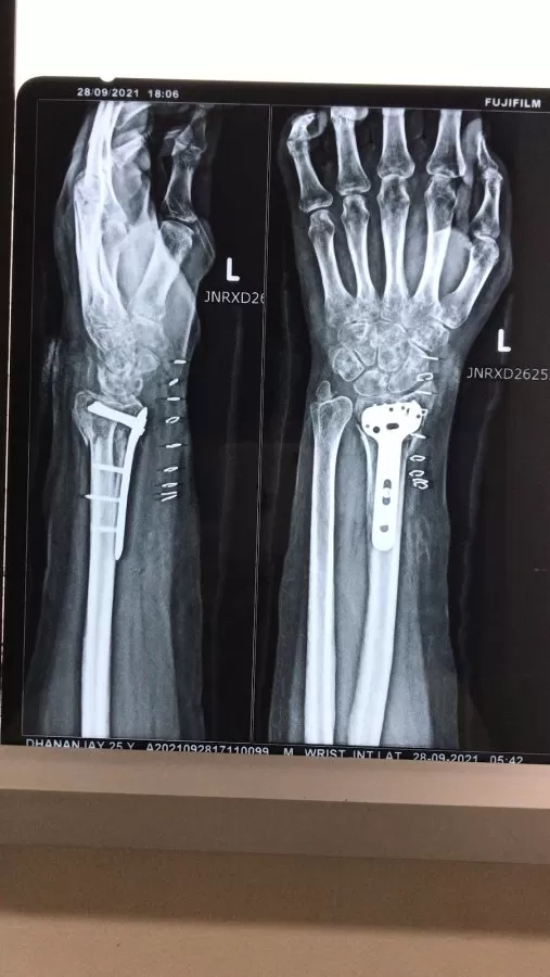 Dr Mithun N Oswal - Best Orthopedic Surgeon in Bangalore- Knee Hip Joint Replacement Surgeon in Bangalore, ACL surgery - Photo 6