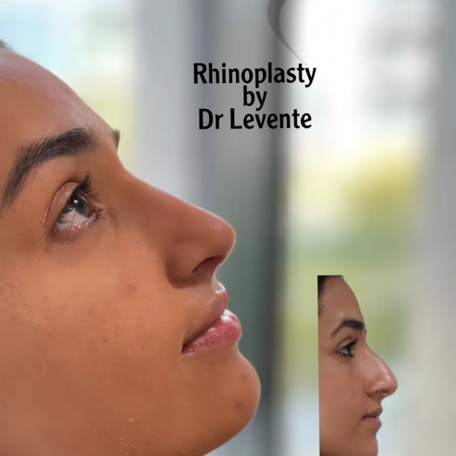 Dr. Levente Deak Rhinoplasty Plastic Surgeon In Dubai - Photo 8