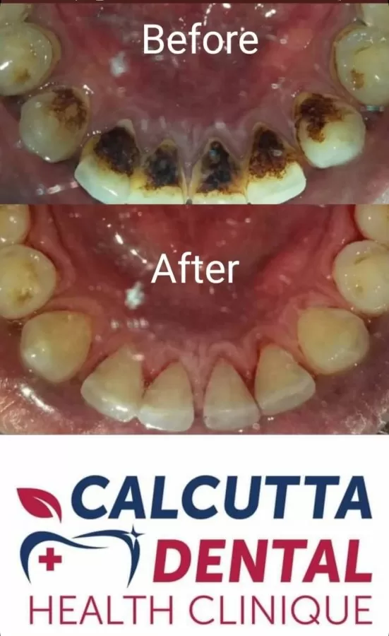 CALCUTTA DENTAL HEALTH CLINIQUE / Dr. Pranay Jaiswal - Photo 5