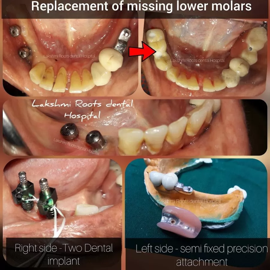 Lakshmi Roots Dental Hospital and Implant Centre- Dr Suganesh BEST DENTIST VILLIVAKKAM - Photo 2