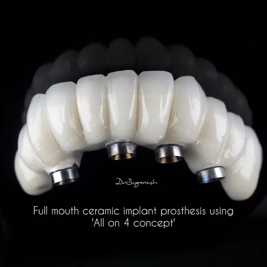 Lakshmi Roots Dental Hospital and Implant Centre- Dr Suganesh BEST DENTIST VILLIVAKKAM - Photo 4