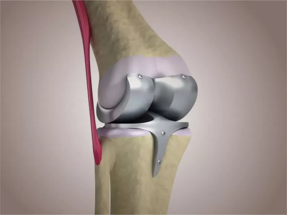 Dr Tejas Gandhi - Best Knee Replacement Doctor & Robotic Knee Replacement Surgeon in Ahmedabad|Gujarat|Rajasthan - Photo 5