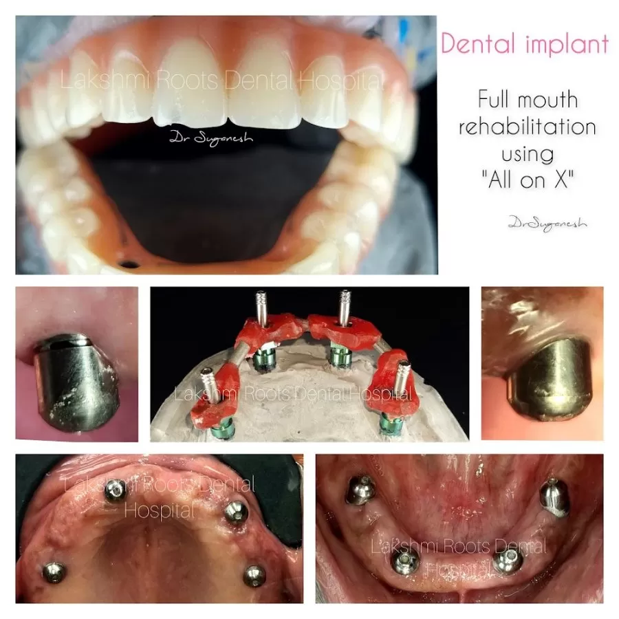 Lakshmi Roots Dental Hospital and Implant Centre- Dr Suganesh BEST DENTIST VILLIVAKKAM - Photo 8