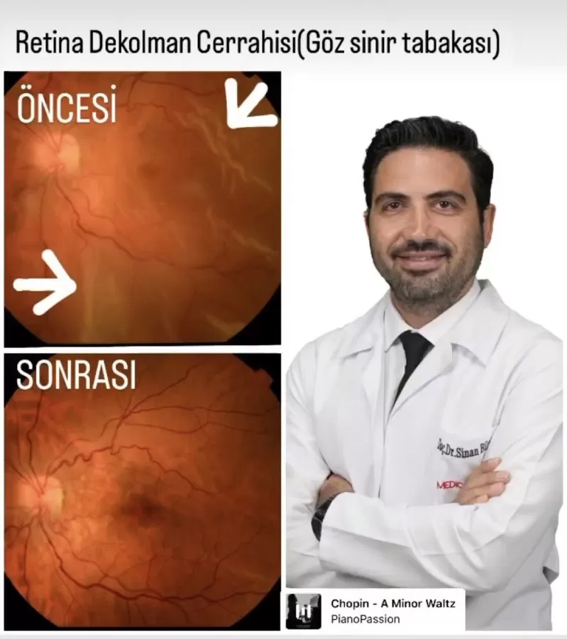 Doç. Op. Dr. Sinan Bilgin / Göz Hastalıkları ve Cerrahisi Uzmanı / Katarakt / Excimer Lazer / Retina - Photo 7