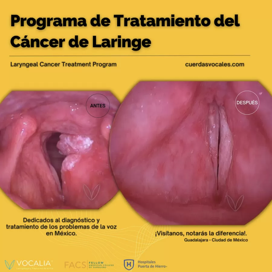 Vocalia Otorrinolaringólogos ® Oídos, Nariz y Garganta, Laringología y Trastornos de la Voz - Dr. Gerardo López Guerra - Photo 8