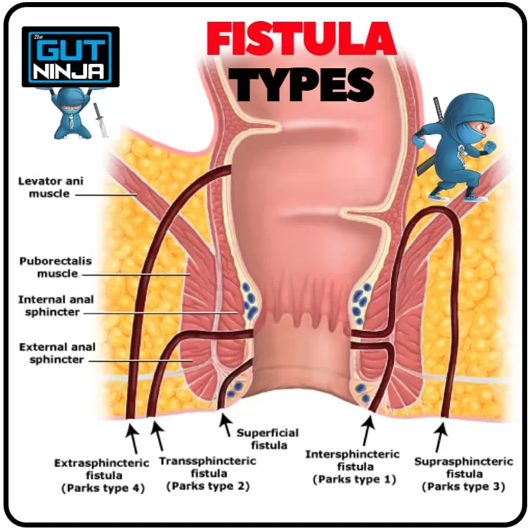 Piles Fissure & Fistula - New Sangavi - Photo 6