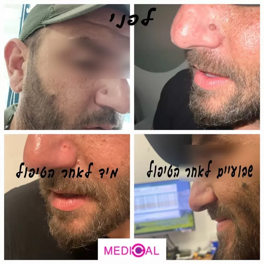 הסרת נגעי עור | הסרת נקודות חן | הסרת קונדילומה | הסרת שומות | אנגיוקרטומה | קסנטלזמה | נקודות אדומות (המנגיומות) - Medical-C - Photo 5