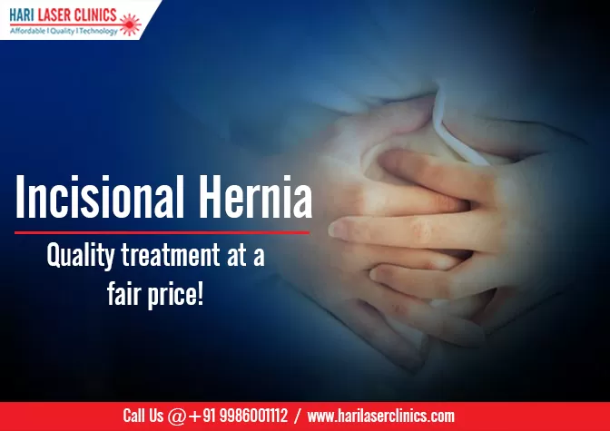 Hari Laser Clinics - Piles, Varicose Veins, Fistula, Fissure - Lipoma - Gynecomastia - Circumcision - Laparoscopic Surgery - Photo 5