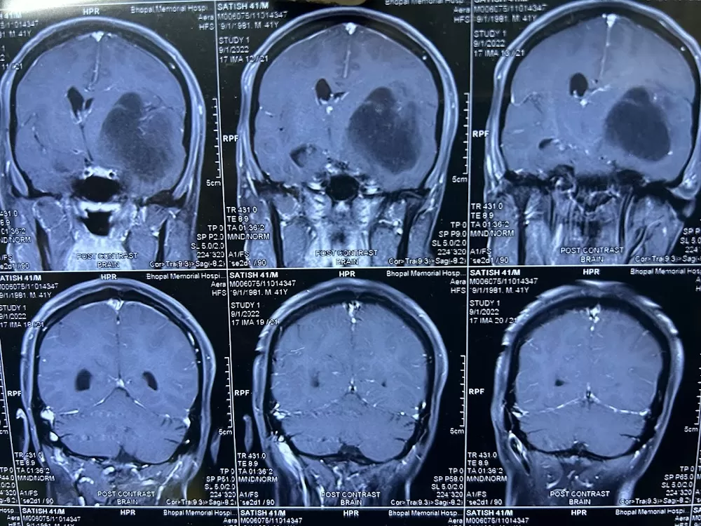 Dr. Anjeev. K. Chaurasiya - Best Neurosurgeon | Brain Tumor | Stroke | Spine Surgeon | Headache | Doctor | Bhopal - Photo 7
