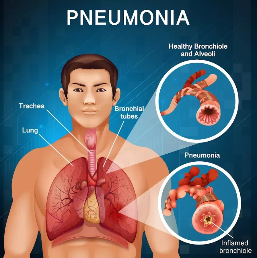 Dr. Pankaj Jain | Consult With Best Pulmonology | Respiratory Medicine Doctor Near Me | Alpha 1 Antitrypsin | 20+ Yrs. of Exp - Photo 7