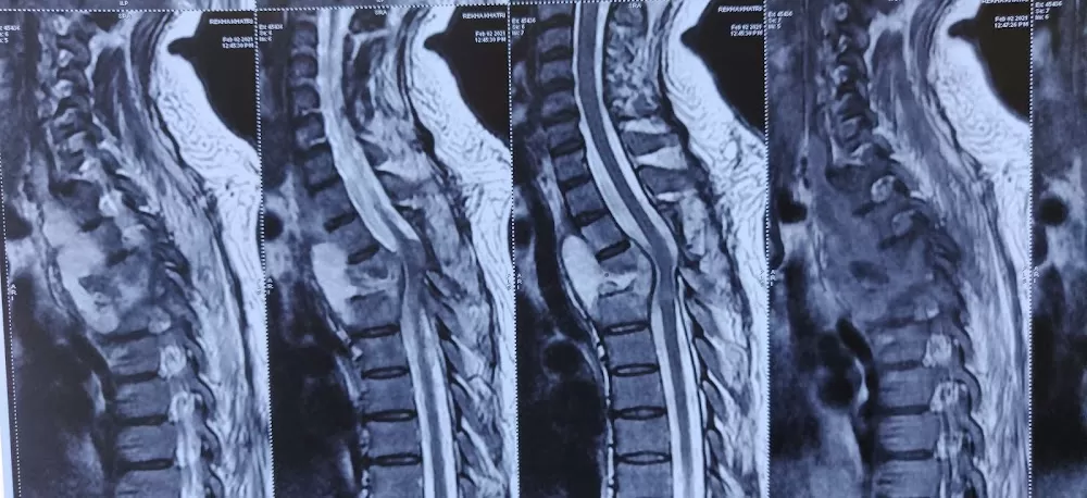 Dr. Anjeev. K. Chaurasiya - Best Neurosurgeon | Brain Tumor | Stroke | Spine Surgeon | Headache | Doctor | Bhopal - Photo 6
