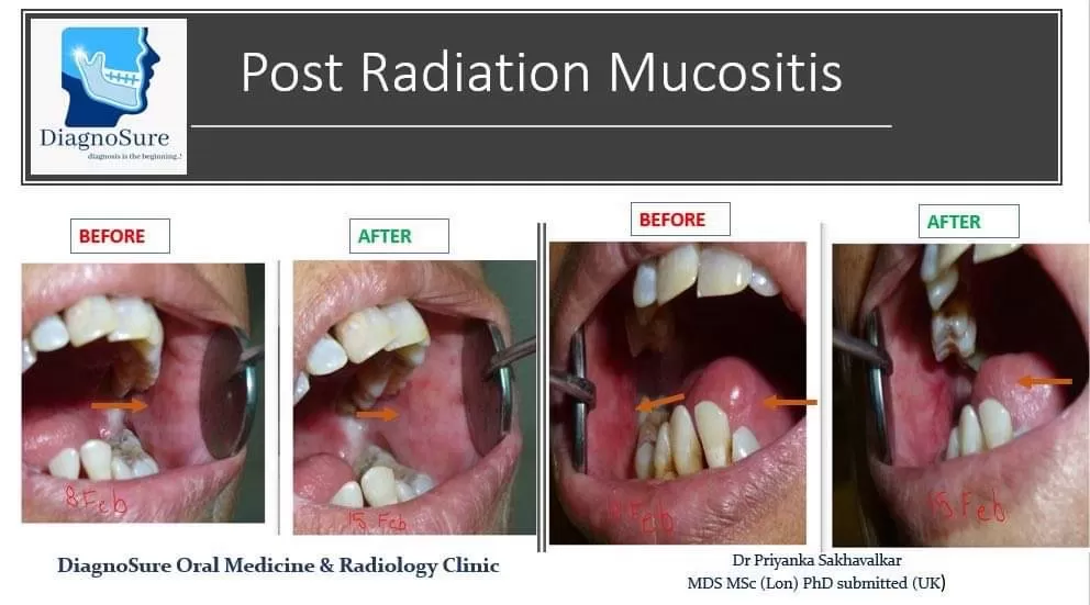 Tilakwadi branch Diagnosure Oral Medicine and Radiology Clinic (Dr.Priyanka Sakhavalkar )/ mouth ulcer doctor / OSMF - Photo 8