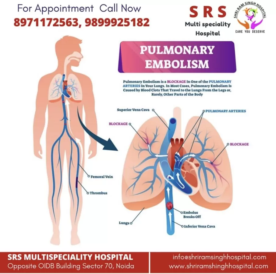 Dr Abhijeet Singh; Pulmonology , Critical Care & Sleep Medicine- MD, DNB,DM (PCCM)- Senior Consultant - Photo 6