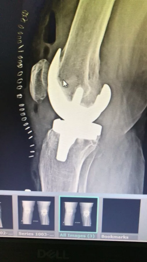 Dr Mithun N Oswal - Best Orthopedic Surgeon in Bangalore- Knee Hip Joint Replacement Surgeon in Bangalore, ACL surgery - Photo 7