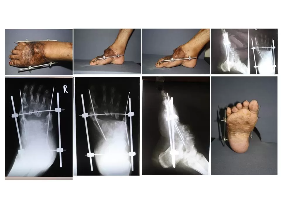 Diabetic Foot & Podiatrist - Visa Medicure - Dr.T.V.Raja - Photo 6