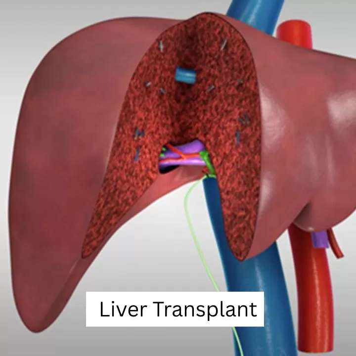 Dr. Gaurav Gupta - Liver Transplant Surgeon in Mumbai | Hepatobiliary Surgeon | HPB Surgeon| Organ Transplant Surgeon Mumbai - Photo 5