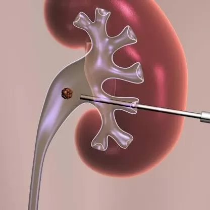 Gultekdi Nursing Home and Lithotripsy Centre. Best Urologist in Pune I Best Lithotripsy Centre in Pune - Photo 8