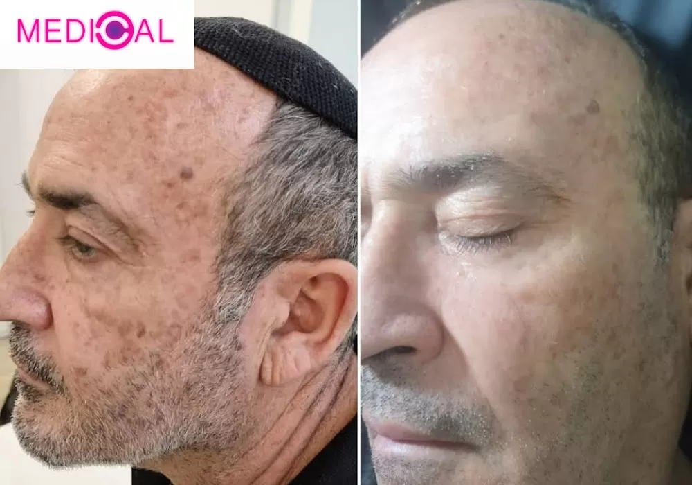 הסרת נגעי עור | הסרת נקודות חן | הסרת קונדילומה | הסרת שומות | אנגיוקרטומה | קסנטלזמה | נקודות אדומות (המנגיומות) - Medical-C - Photo 2