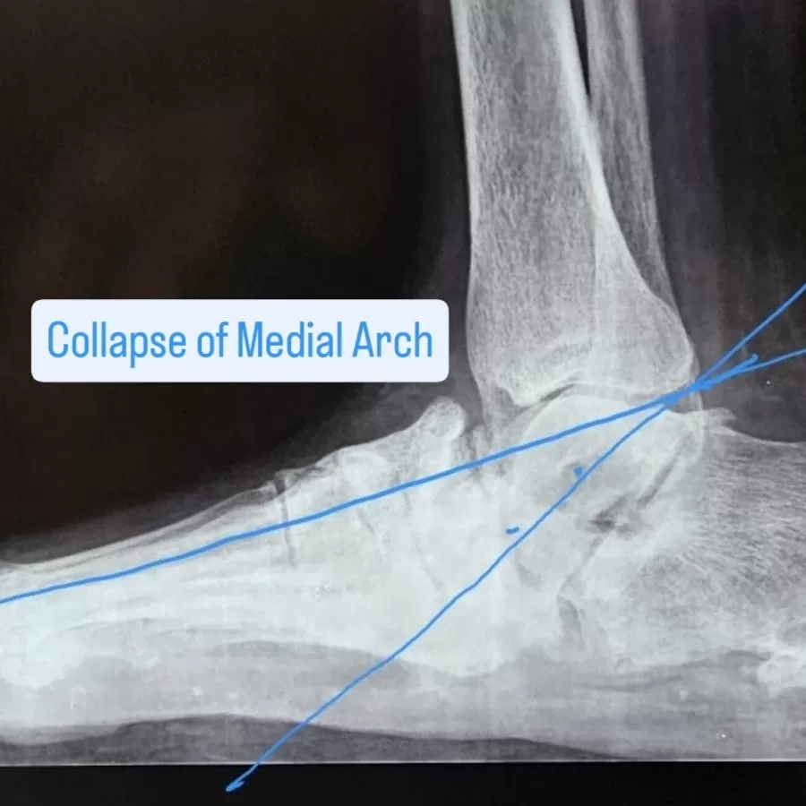 Dr. Varun Kommalapati | Consultant Orthopedic Surgeon | Best Orthopaedic Diabetic & Charcot Foot Expert in Hyderabad | - Photo 5