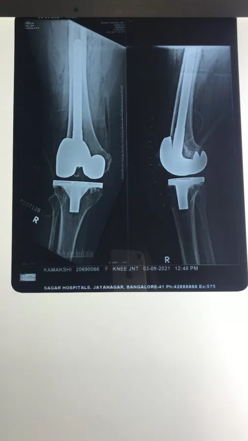 Dr Mithun N Oswal - Best Orthopedic Surgeon in Bangalore- Knee Hip Joint Replacement Surgeon in Bangalore, ACL surgery - Photo 3