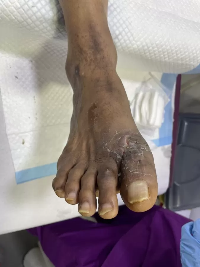 CDFC HOSPITAL-Chennai Diabetic Foot Care Centre - Photo 7