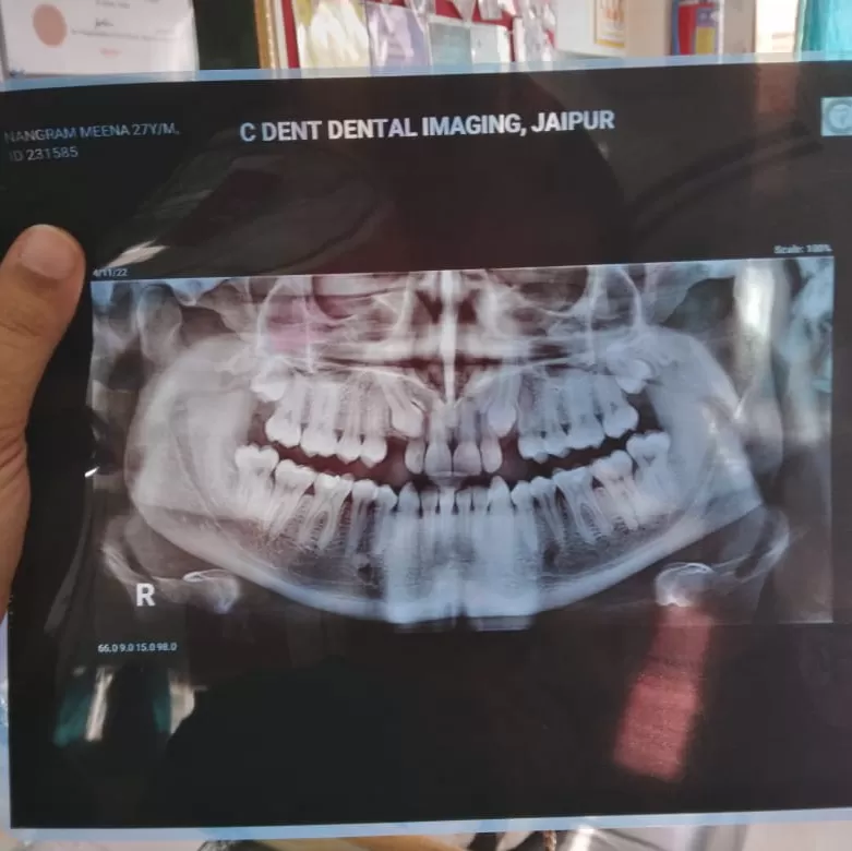 Dr Somendra Dental Clinic And Implant Center Government empanelled RGHS,CGHS,ECHS,JVVNL,NBC,AYUSHMAN CAPF - Photo 4