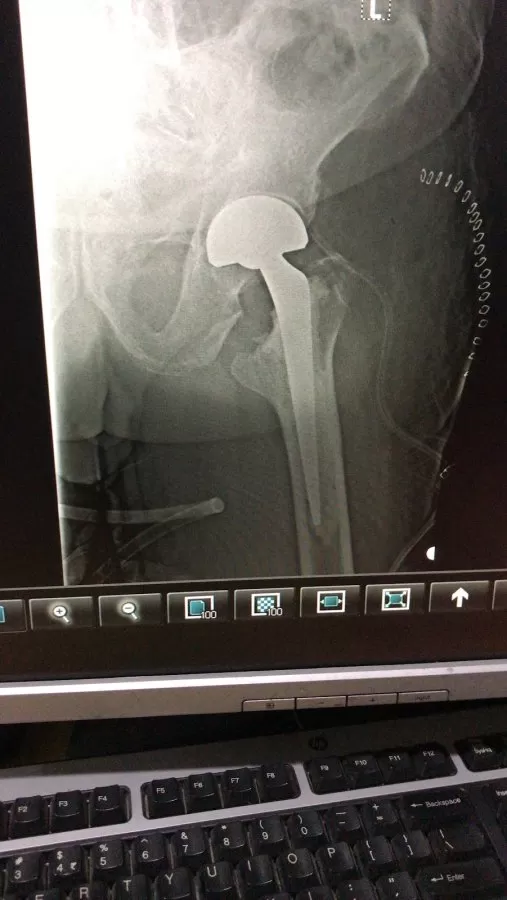 Dr Mithun N Oswal - Best Orthopedic Surgeon in Bangalore- Knee Hip Joint Replacement Surgeon in Bangalore, ACL surgery - Photo 2