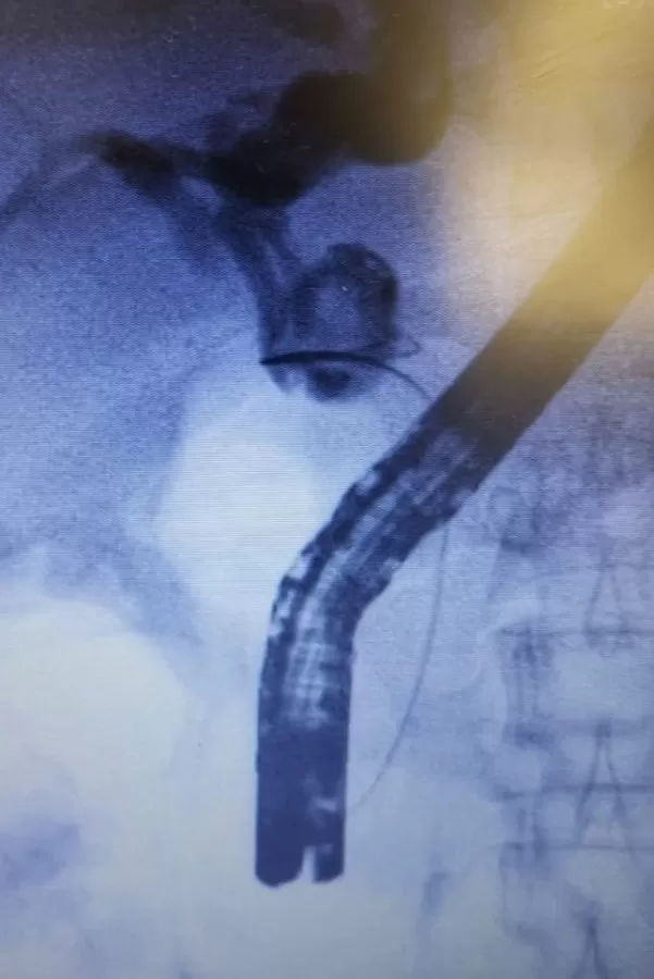 Gallstones, Hernias, Reflux, Gastric Cancer, Weight Loss Surgery & Endoscopy - Dr Toh Bin Chet Resurgence Surgical Clinic - Photo 6