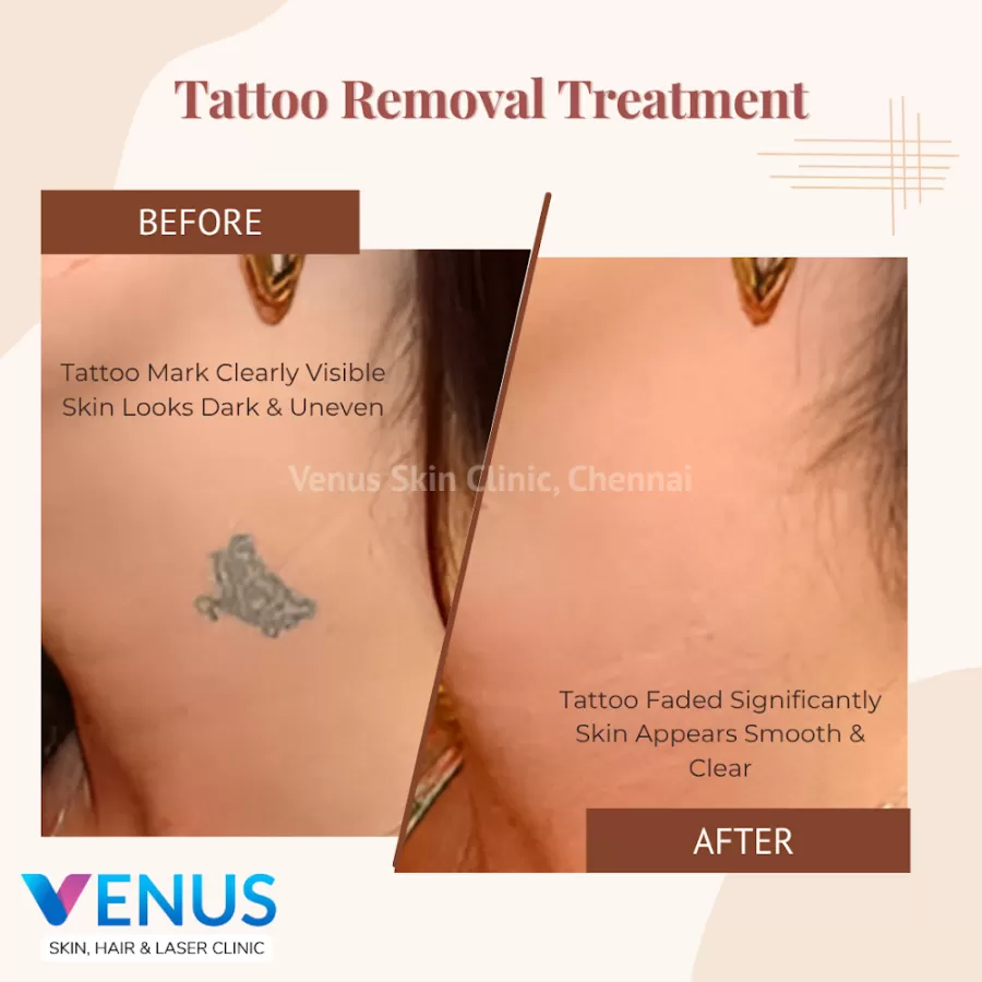 Venus Skin Clinic – Dr.Sharanya K, MD Dermatologist | Skin Care Specialist in Chennai - Photo 2