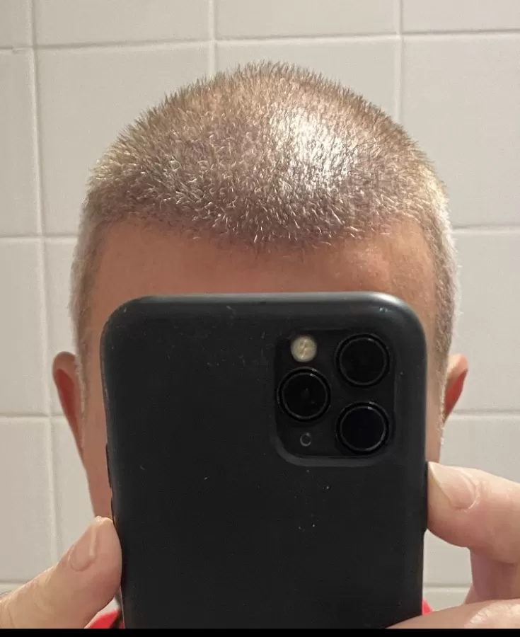 Hair Transplant Institute - Dra. Alba Reyes Sagiv - Photo 6