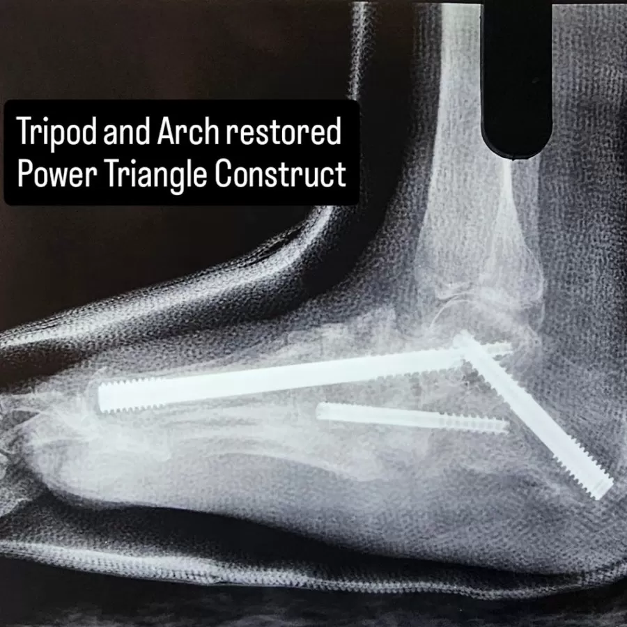 Dr. Varun Kommalapati | Consultant Orthopedic Surgeon | Best Orthopaedic Diabetic & Charcot Foot Expert in Hyderabad | - Photo 2