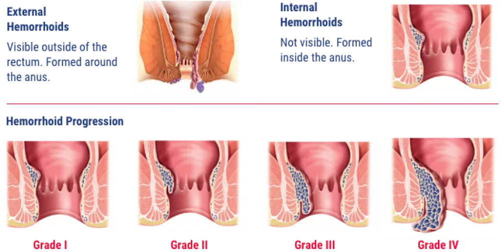 Cosmocare Piles and Hernia Center - Photo 8