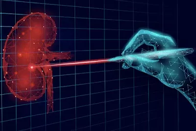 Urolaser Solutions