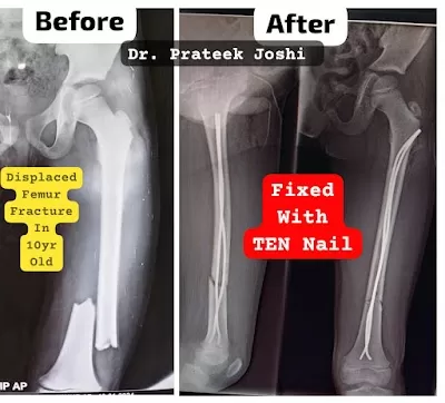 Atharva Orthopaedic Super Speciality Hospital | Dr. Prateek Joshi