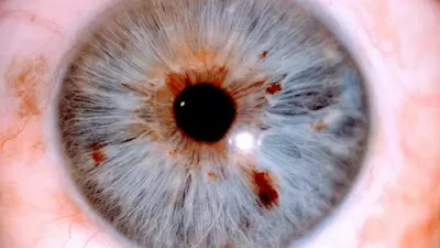Cornea Eye Hospital- Best Eye Hospital/ Cornea transplant / Keratoconus /